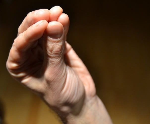 istoric de artrită periferică a articulației umărului inflamația articulară a degetului mare