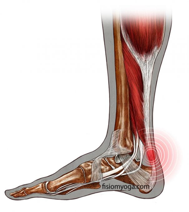 Tendinitis aquilea